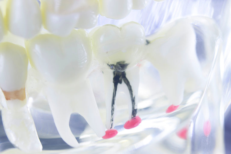 Dental tooth root canal root canal