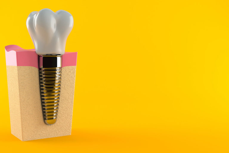 Blog-Dental-implant The Benefits of Dental Implants